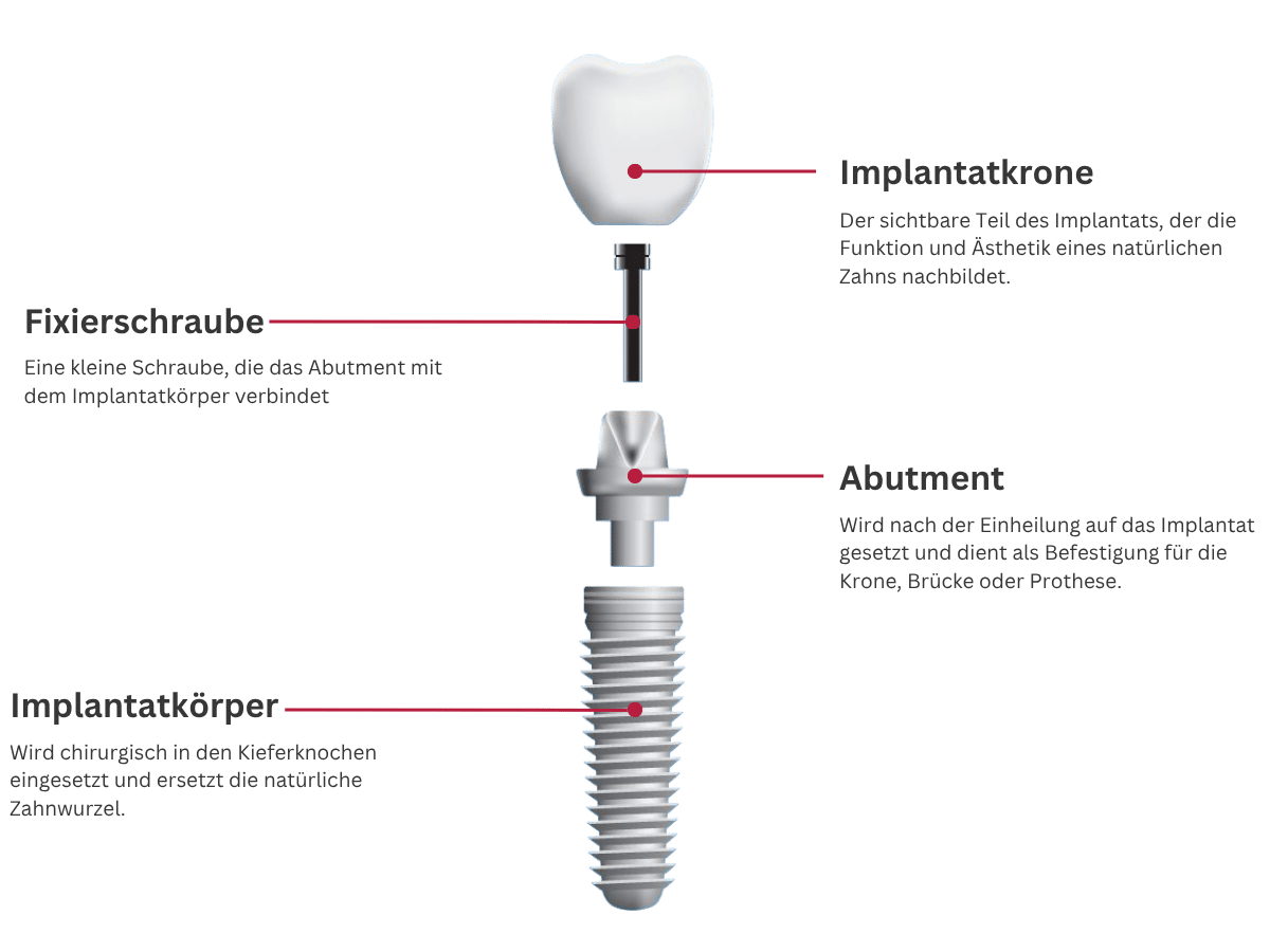 Implantat Aufbau 3