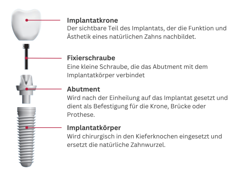 Implantataufbau Mobile 2